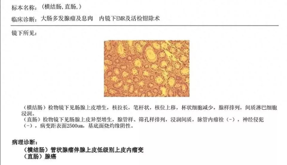 没有便血，39岁确诊直肠癌